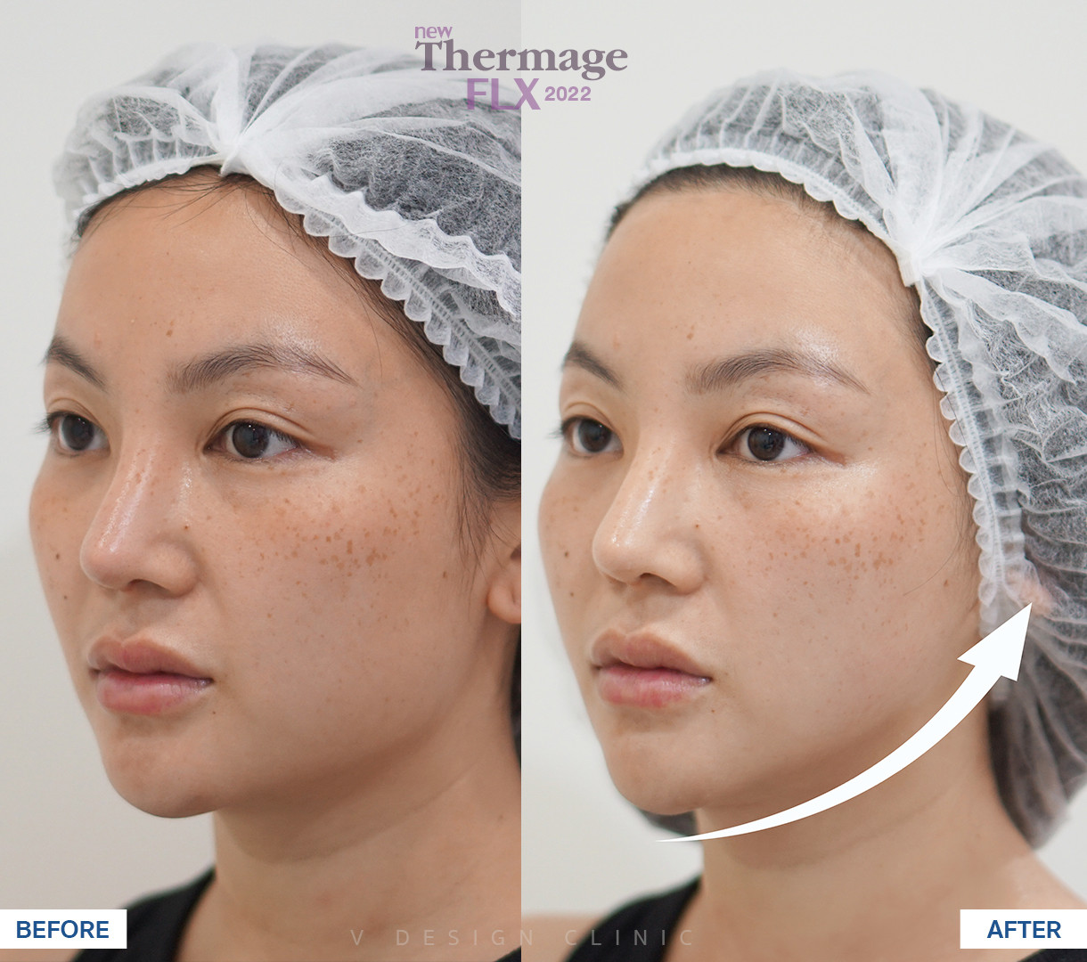 รีวิว Thermage Vdesign  