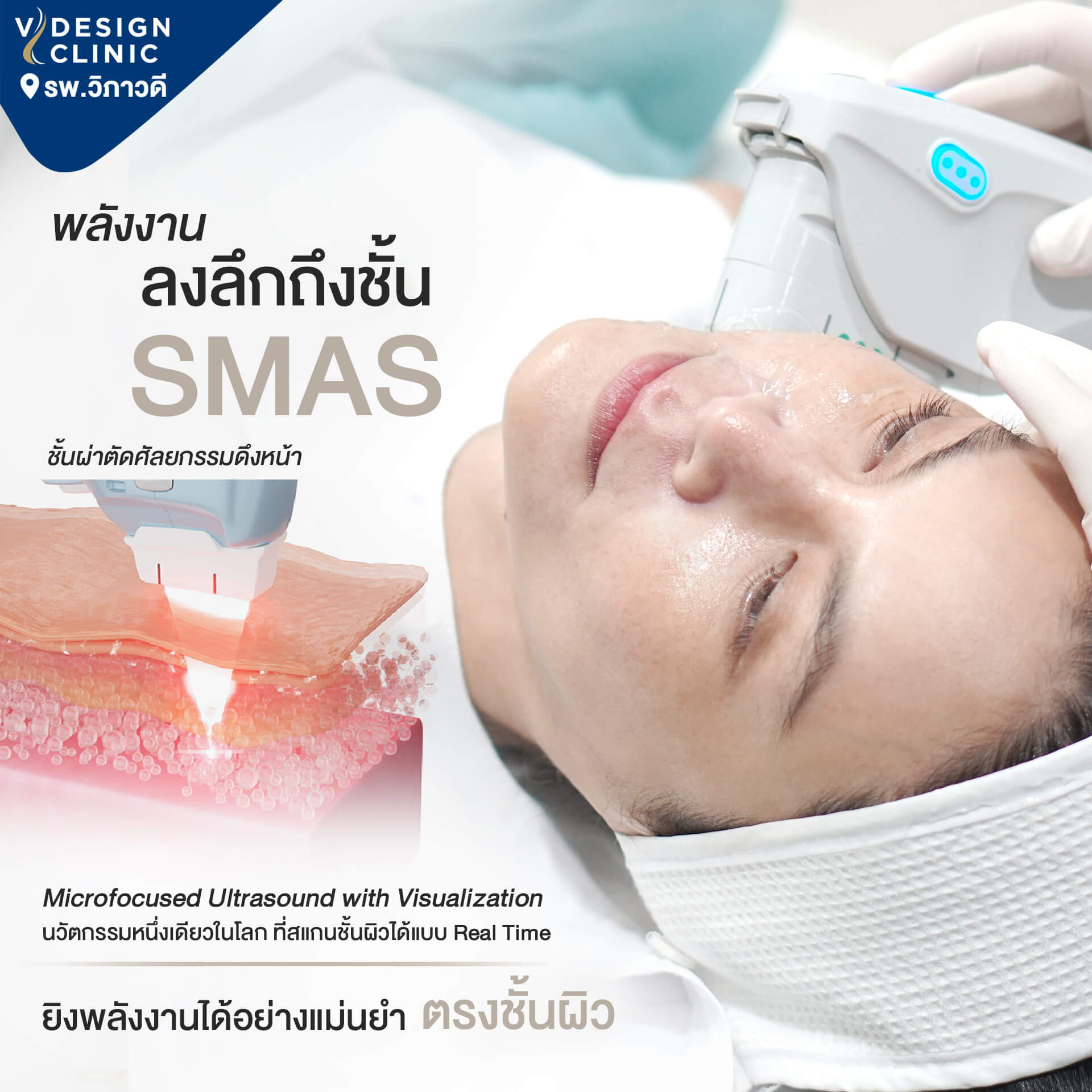 ชั้นผิว SMAS