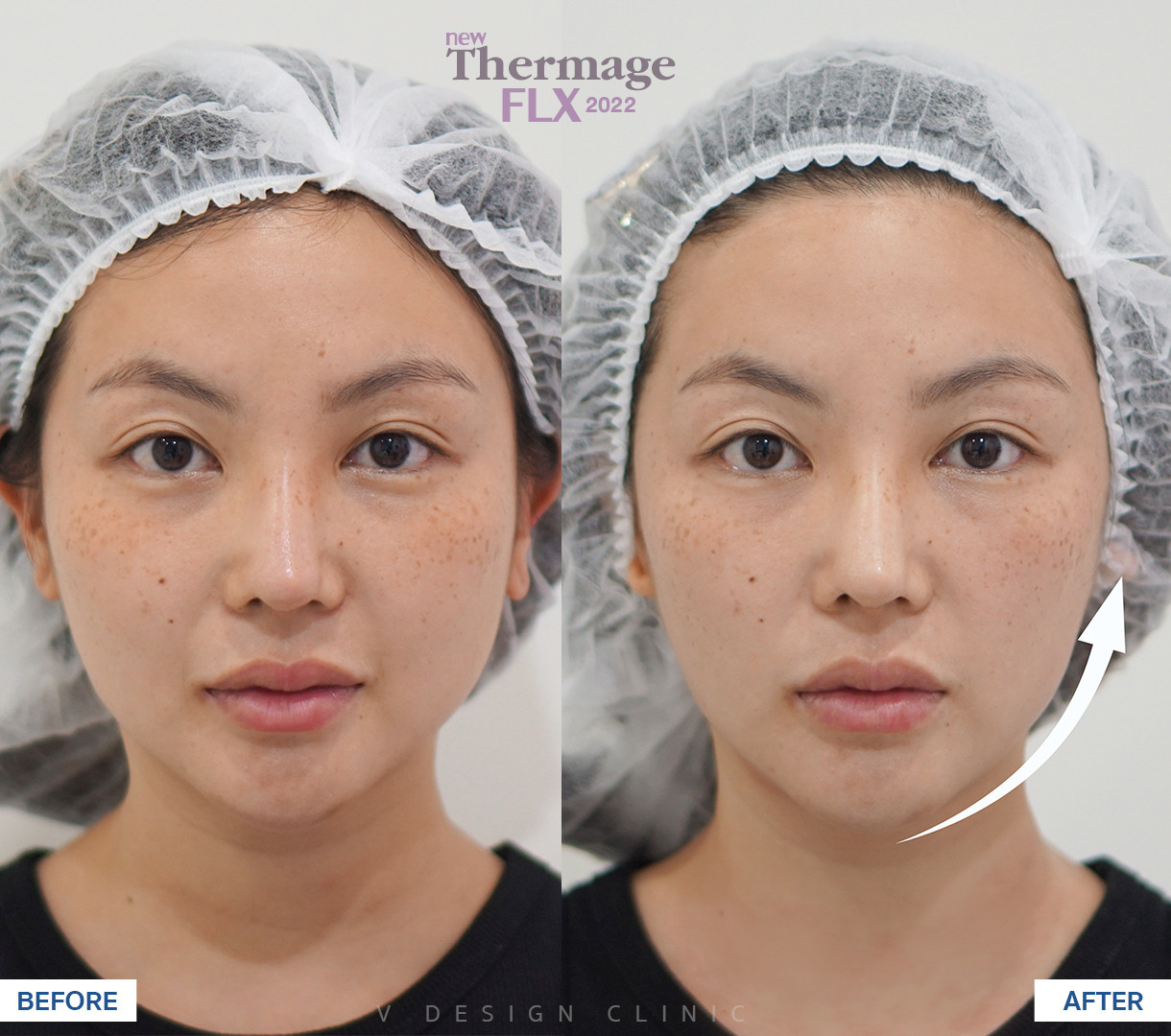 รีวิว Thermage  