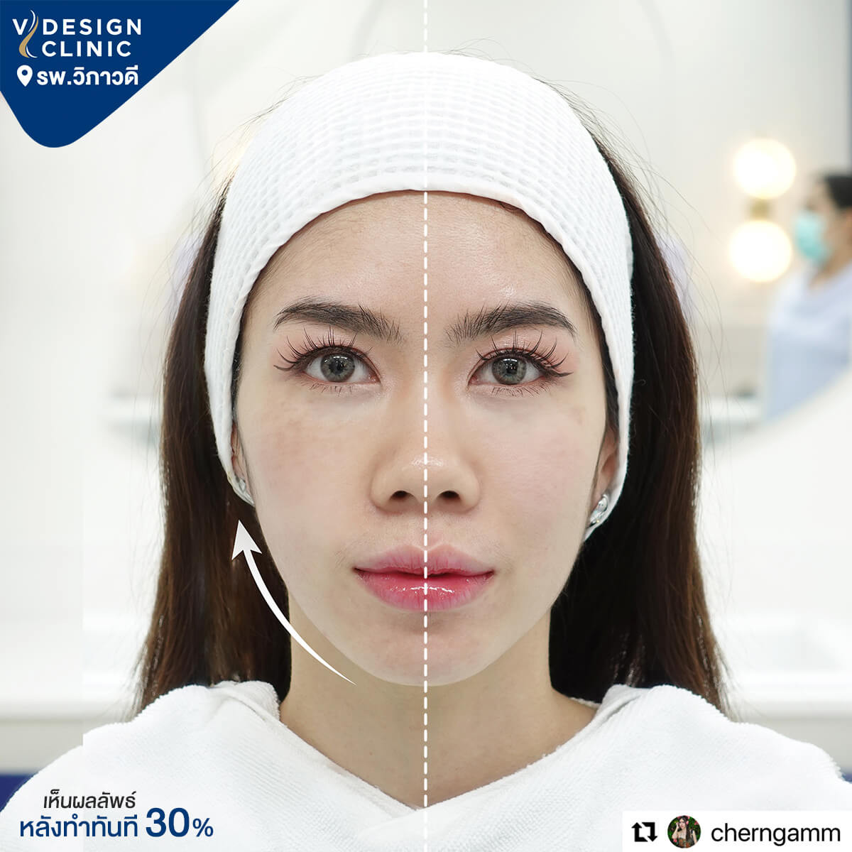 รีวิว Vdesign Clinic