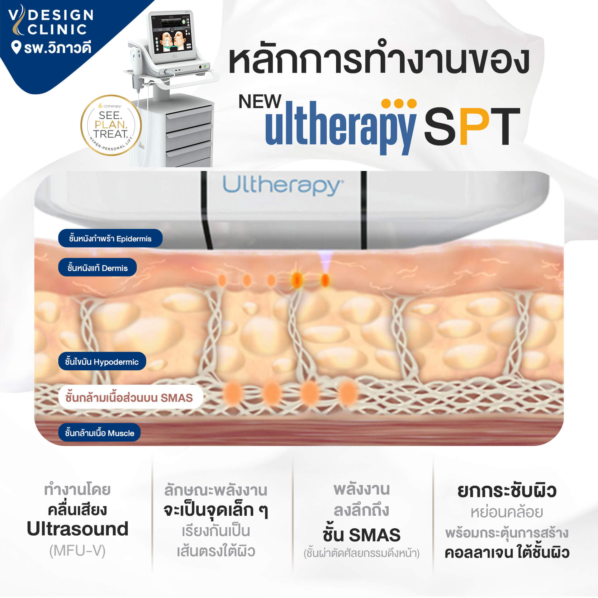 ข้อดีของ Ulthera SPT