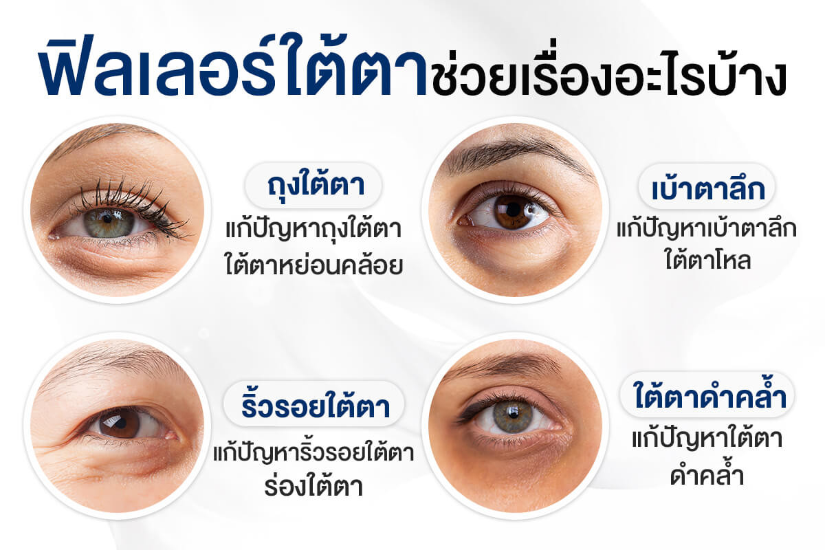 ปัญหาใต้ตา