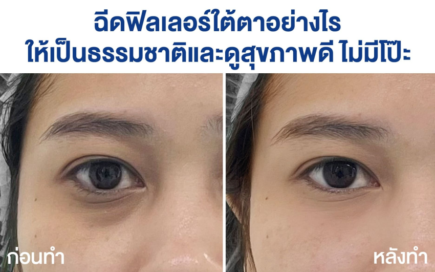 ฉีดฟิลเลอร์ใต้ตา ให้เป็นธรรมชาติและดูสุขภาพดี ไม่มีโป๊ะ